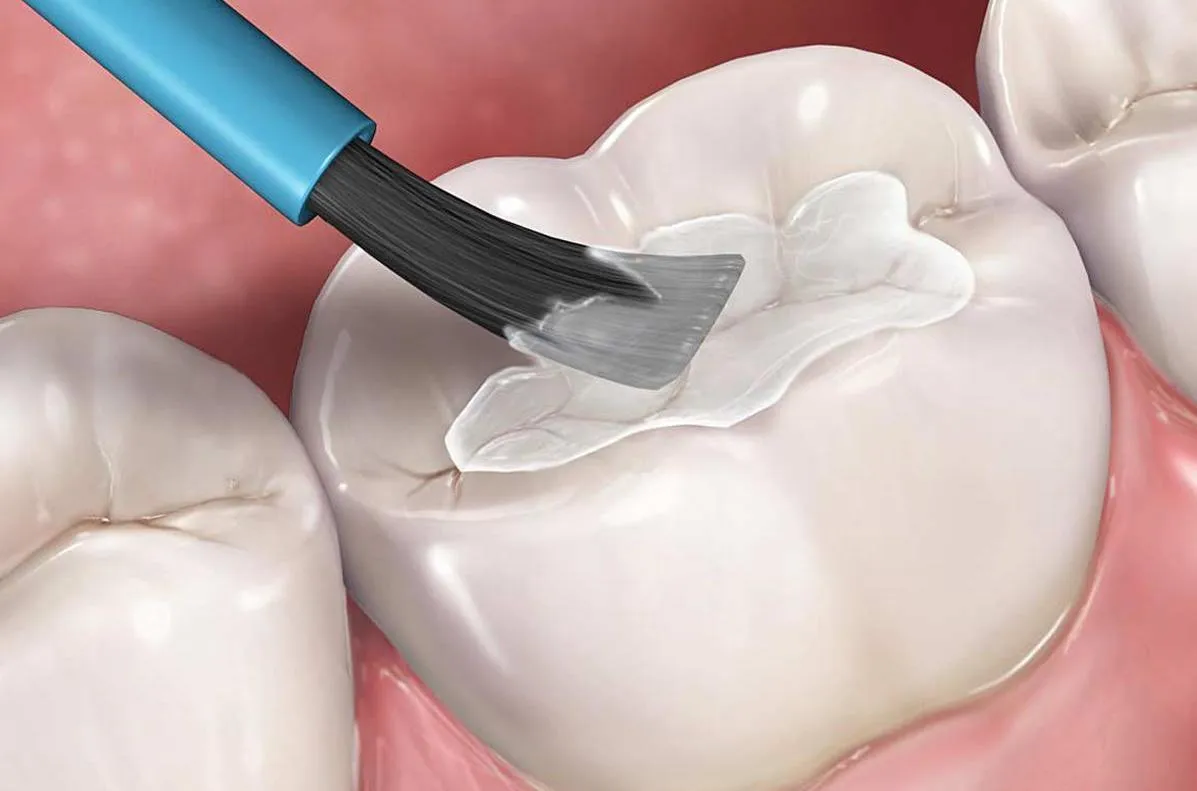 Trám răng thẩm mỹ và những thông tin quan trọng bạn cần biết