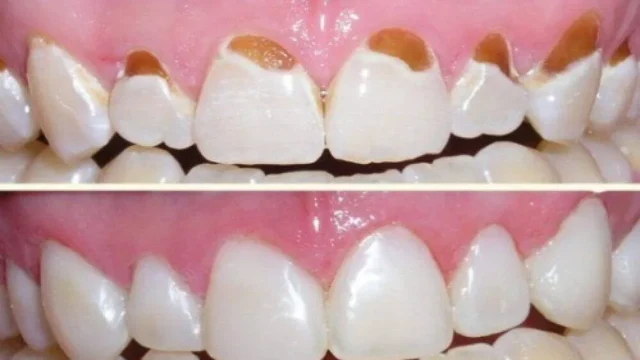 cach-tri-e-buot-rang-dan-gian-hieu-qua-tai-nha-2