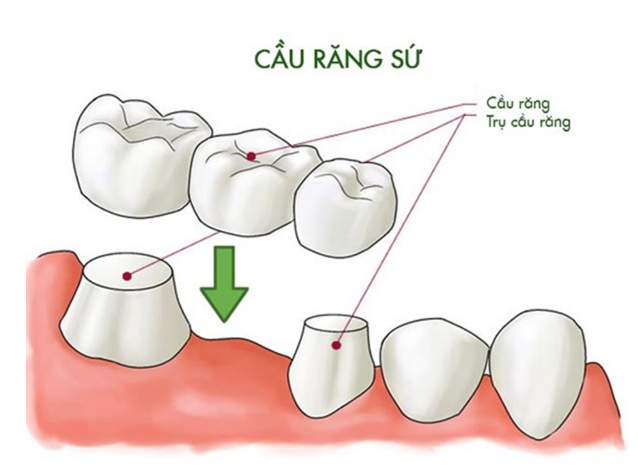 cau-rang-su