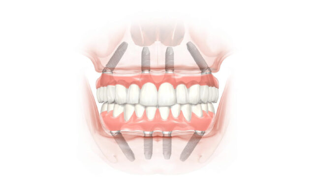 uu-diem-trong-rang-implant-all-on-4