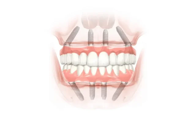 uu-diem-trong-rang-implant-all-on-4