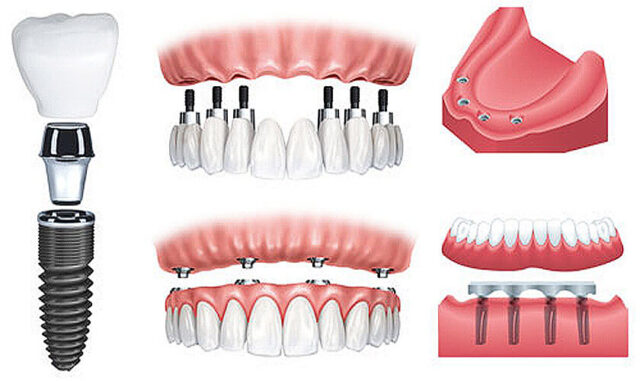 nhuoc-diem-trong-rang-implant-all-on-4