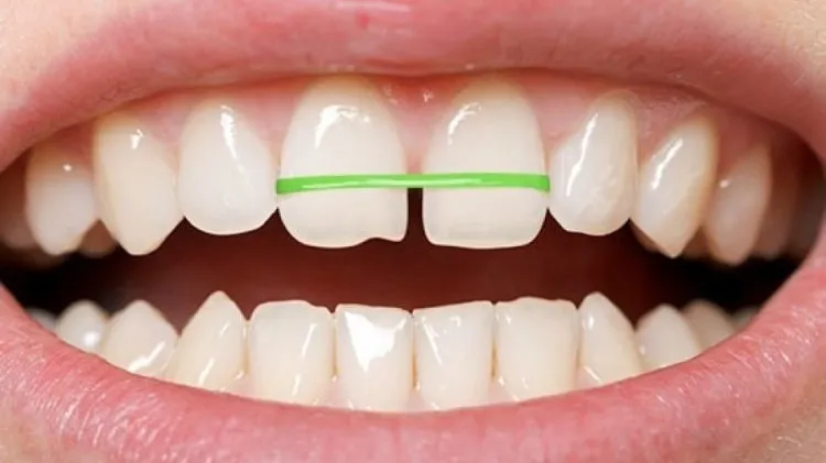 nieng-rang-tai-nha-2