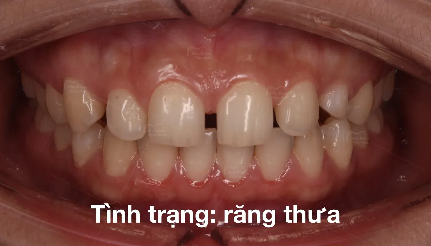 nieng-rang-thua-0