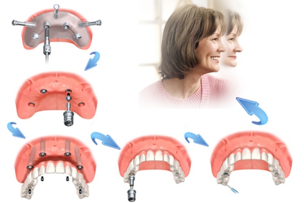 trong-rang-implant-all-on-4-1