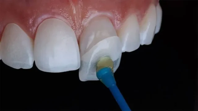 Khái niệm bonding răng trong nha khoa