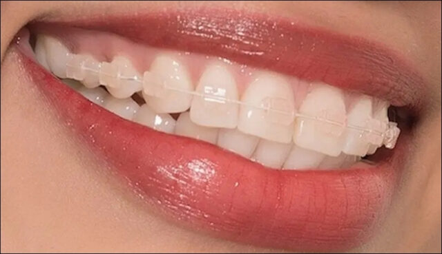 nieng-rang-mac-cai-pha-le-1