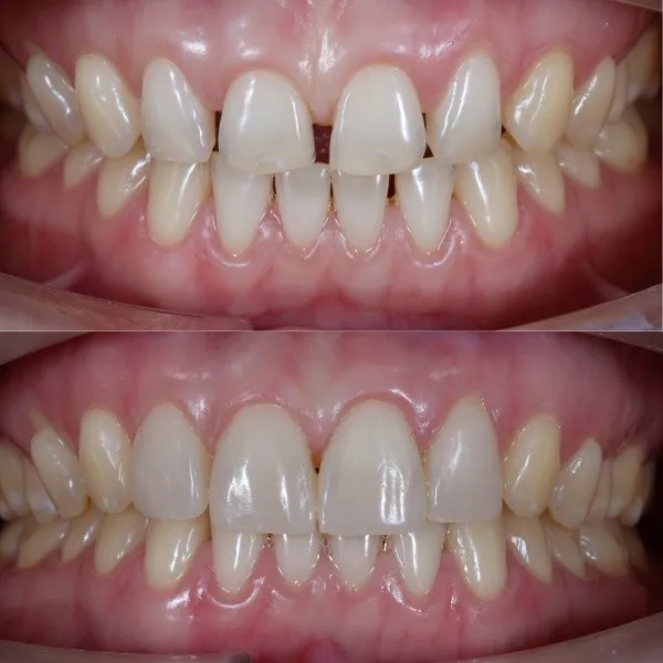 phuong-phap-dan-rang-composite-3
