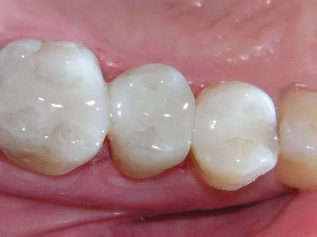 phuong-phap-dan-rang-composite