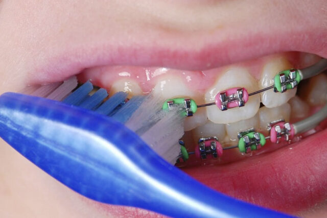 ve-sinh-rang-sau-nieng