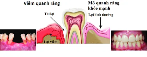 viem-quanh-rang-1