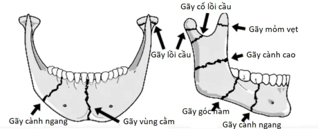 chan-thuong-vung-mat-3