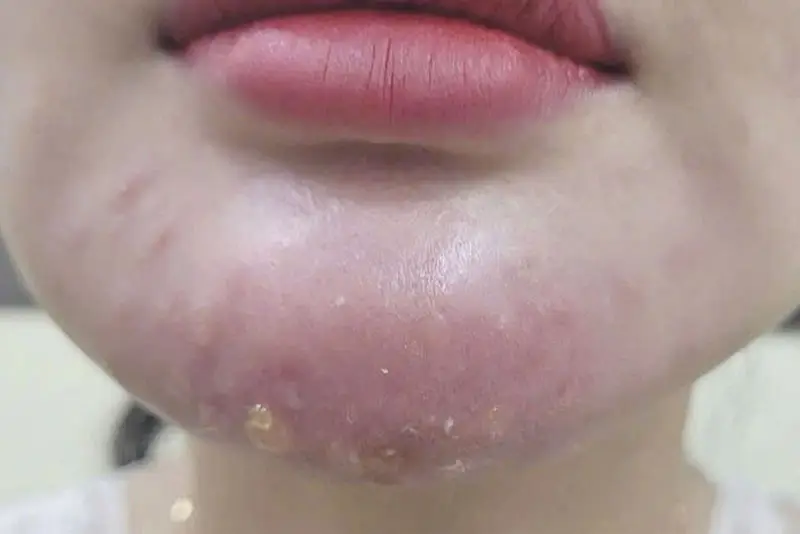 chan-thuong-vung-mat-4