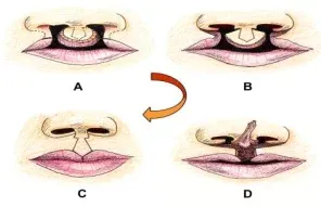 di-tat-bam-sinh-vung-mieng-moi-2