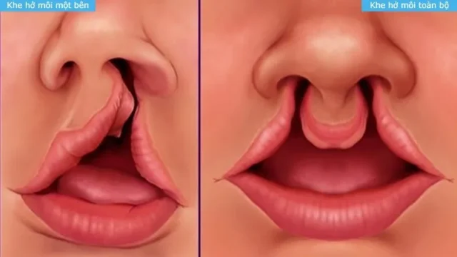 di-tat-bam-sinh-vung-mieng-moi