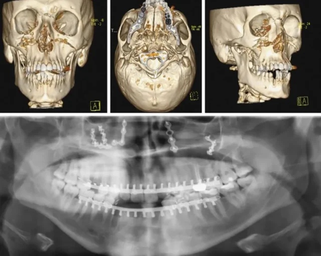 dieu-tri-chan-thuong-ham-mat-da-tang-4