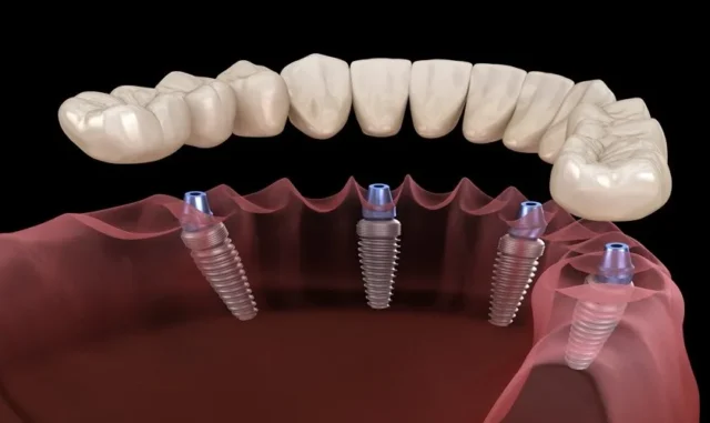ky-thuat-cay-ghep-implant-phuc-tap-1