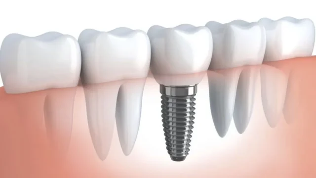 ky-thuat-cay-ghep-implant-phuc-tap-4