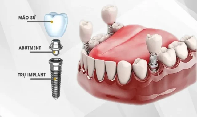 ky-thuat-cay-ghep-implant-phuc-tap