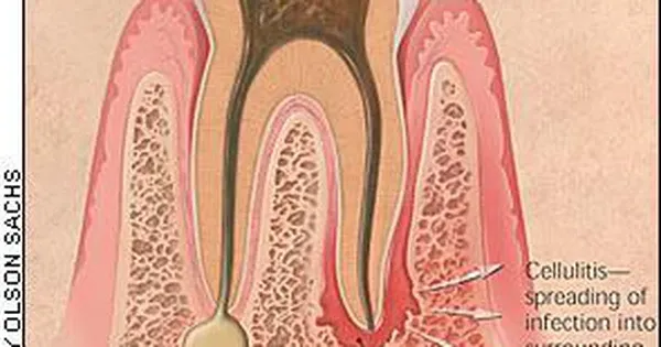 nhiem-trung-lan-toa-vung-ham-mat-1