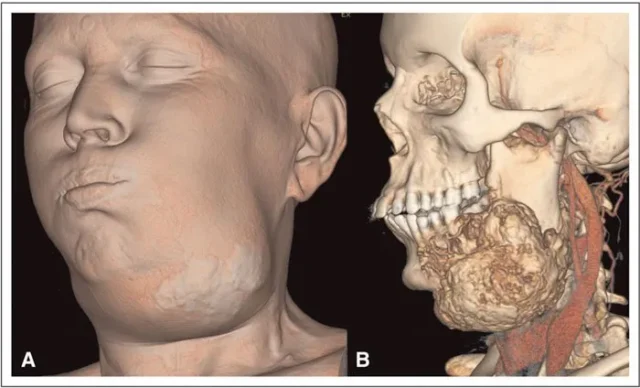 cat-bo-khoi-u-xuong-ham-2