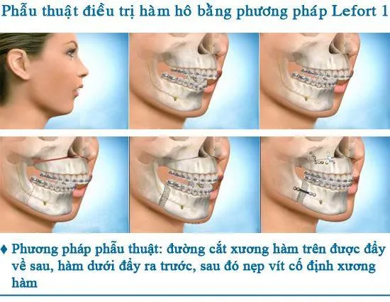phau-thuat-chinh-hinh-xuong-ham
