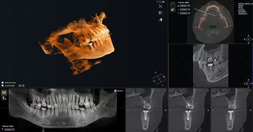phau-thuat-tai-tao-xuong-o-rang-4