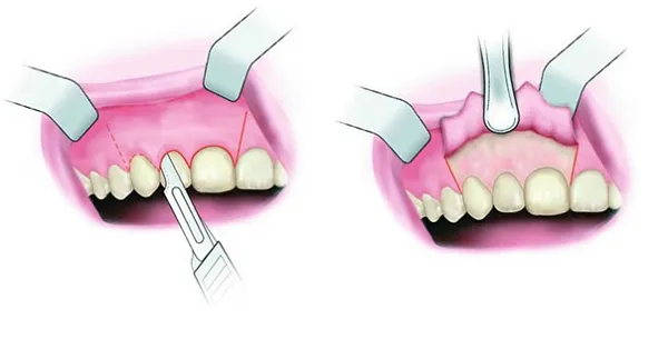 phau-thuat-tai-tao-xuong-o-rang