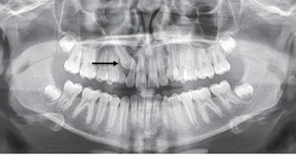 rang-so-3-moc-ngam-1