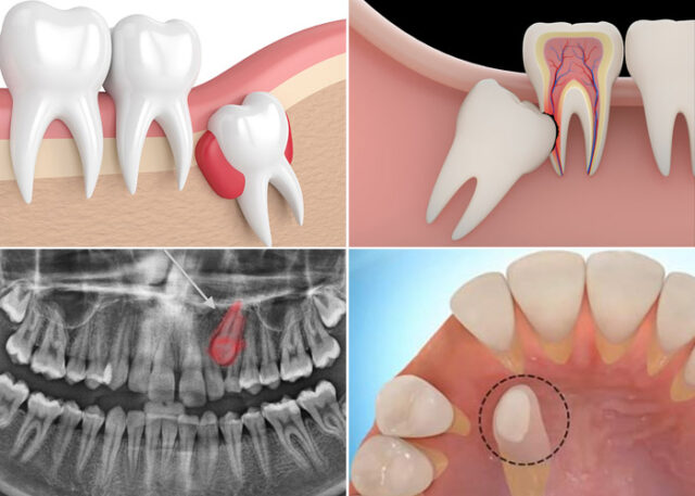 rang-so-3-moc-ngam-2
