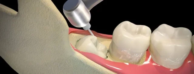 rang-so-8-moc-ngam-4