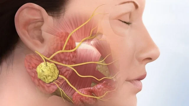 cat-bo-khoi-u-xuong-ham-1