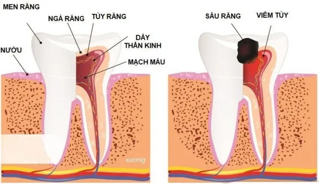 viem-tuy-xuong-ham-man-tinh