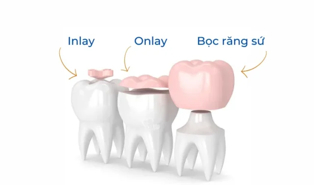 bọc răng sứ có phải mài răng không