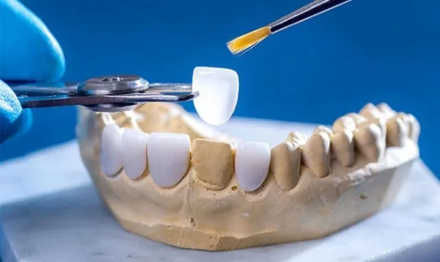 răng sứ dùng được bao nhiêu năm