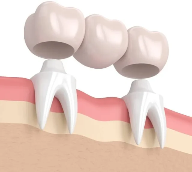 Bắc cầu răng là phương pháp phục hình cố định