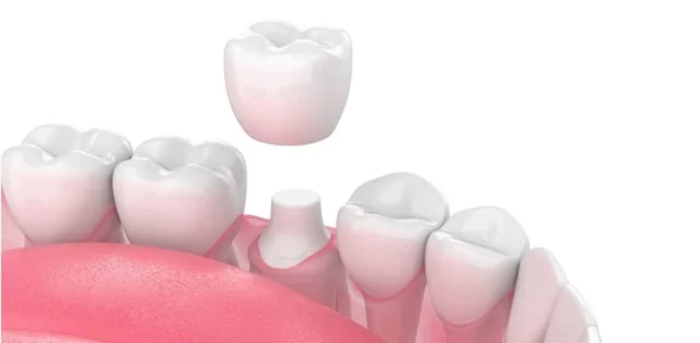 bọc răng sứ có phải mài răng không