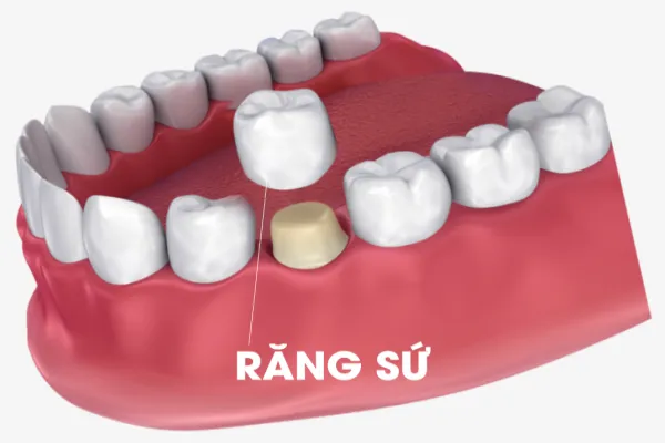 boc-rang-su-hai-phong-1