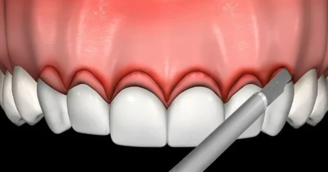 Cắt lợi, hay còn gọi là phẫu thuật tạo hình nướu,