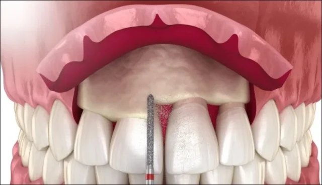 Mức Độ Thực Tế Khi Cắt Lợi
