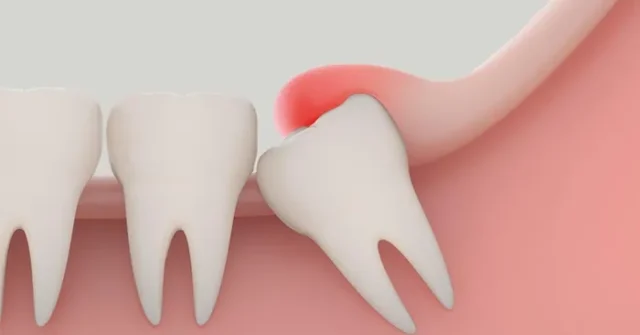 Dấu Hiệu Lợi Trùm Cần Cắt