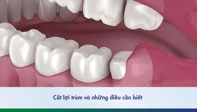 Những điều cần biết khi cắt lợi trùm