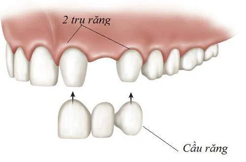 Ưu điểm và nhược điểm của cầu răng cửa
