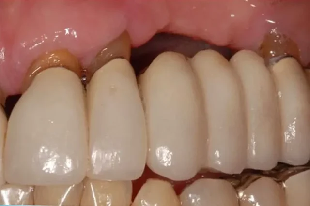Quy Trình Thực Hiện Cầu Răng Sứ Chi Tiết