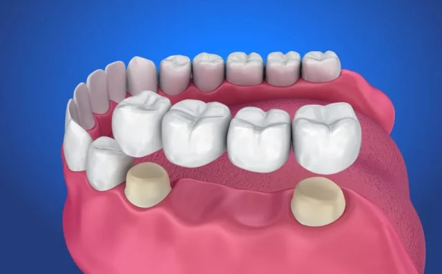 Cấu Tạo & Các Loại Cầu Răng Sứ Phổ Biến