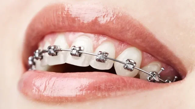 Chi phí niềng răng