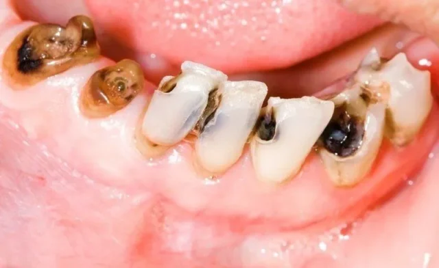 Dấu hiệu nhận biết răng sâu cần điều trị