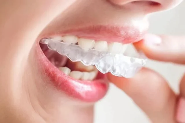 Lưu ý và chăm sóc khi sử dụng Invisalign