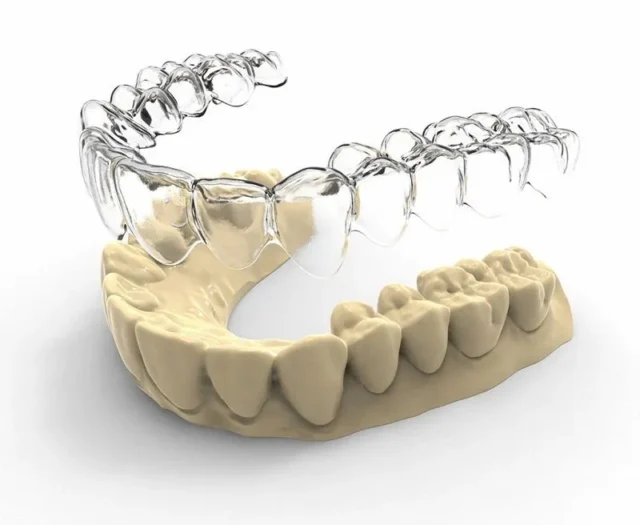 Lợi ích của công nghệ Invisalign