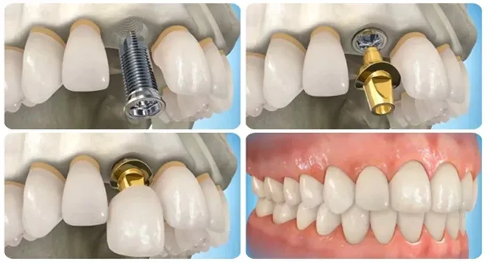 dich-vu-trong-rang-implant-hai-phong-3